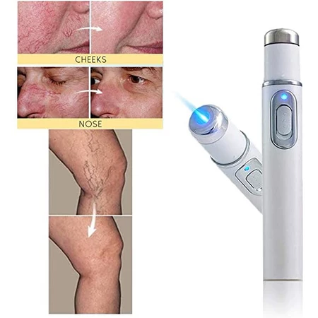 Caneta Laser Removedora de Varizes Variclean [BRINDE]