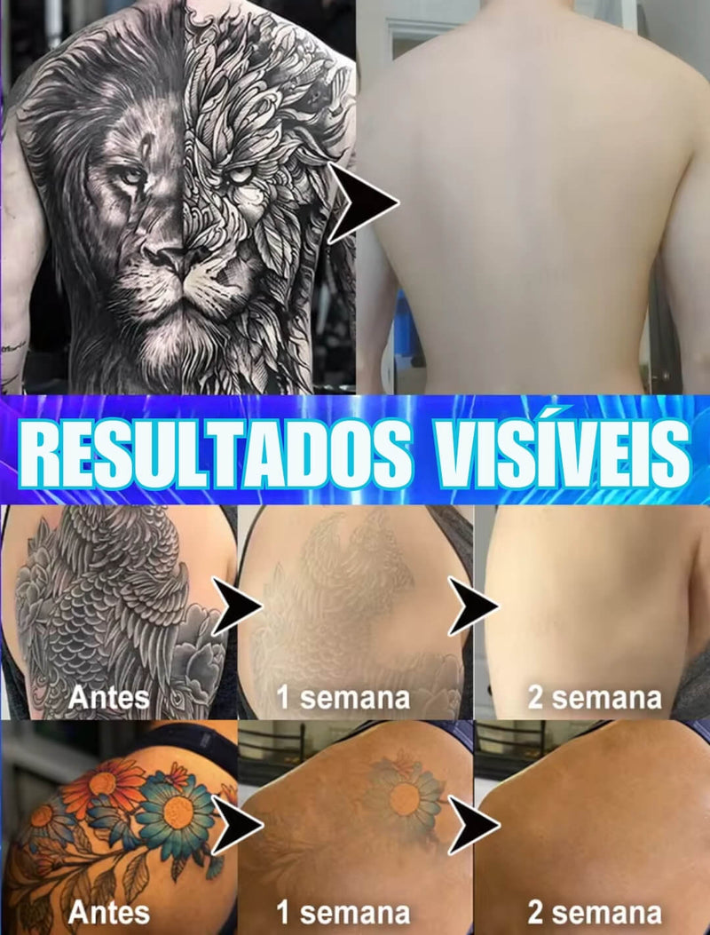 Caneta Removedora de Tatuagens - RemovalClean