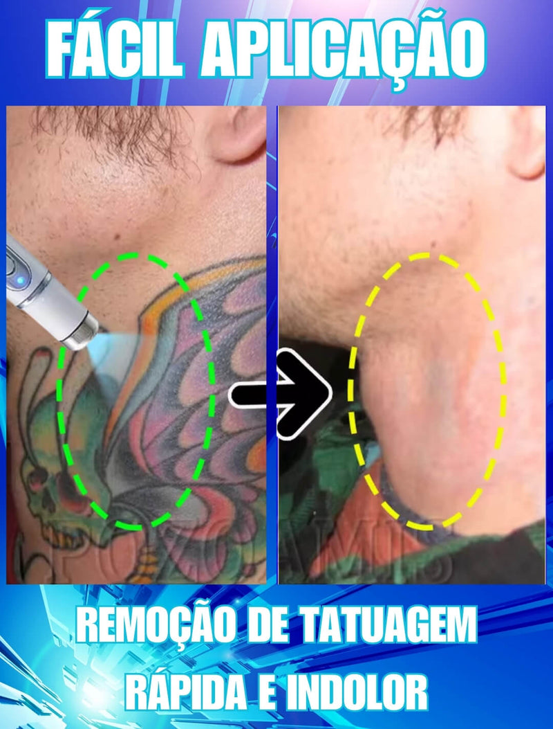 Caneta Removedora de Tatuagens - RemovalClean